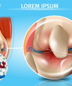 Sản phẩm gia công thực phẩm chức năng phòng chống thoái hóa khớp: Bí quyết giữ khớp luôn khỏe mạnh